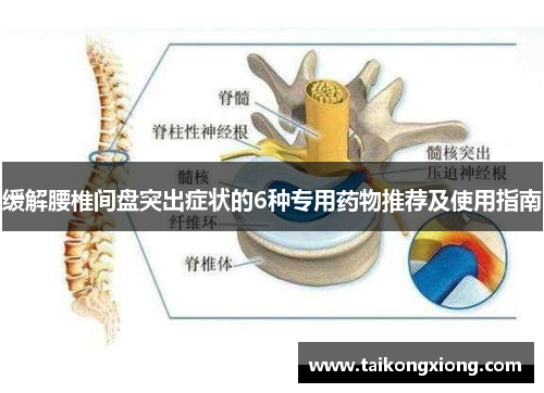 缓解腰椎间盘突出症状的6种专用药物推荐及使用指南